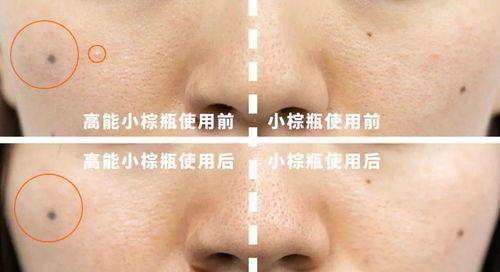 甲亢可以吃兰瓜吗,甲亢患者适宜食用兰瓜的探讨